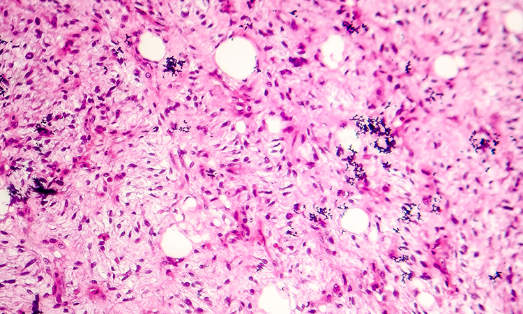 Sarcoma cancer tissue