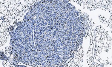 Study shows that lung tumour growth can be reduced by inhibiting p38