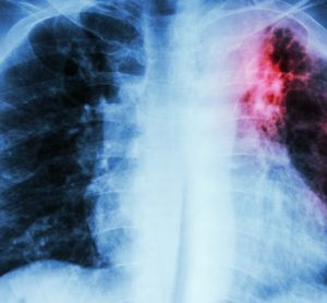 Tuberculosis in lungs
