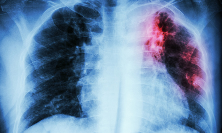 Tuberculosis in lungs