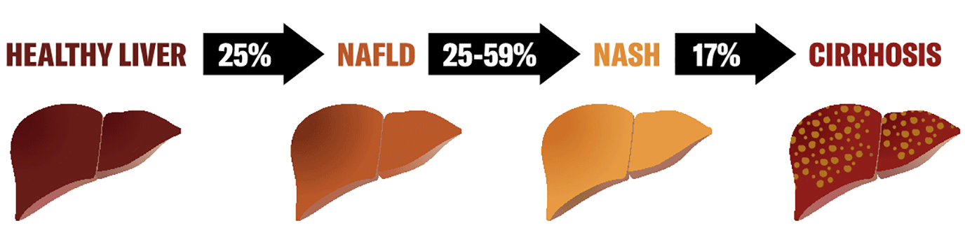 Figure 1: Incidence of NAFLD progression: from healthy liver to cirrhosis. Figure designed by and courtesy of Carolina Rey-Bedon, Milan, Italy.