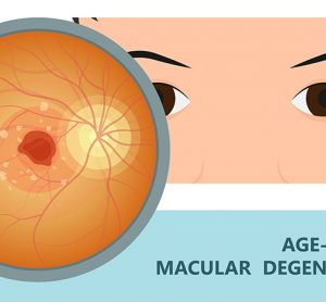 age-related macular degeneration (AMD