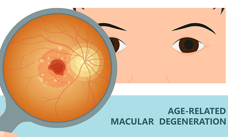 age-related macular degeneration (AMD