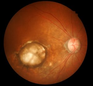 opticians image of the retina with a large area of macular degeneration