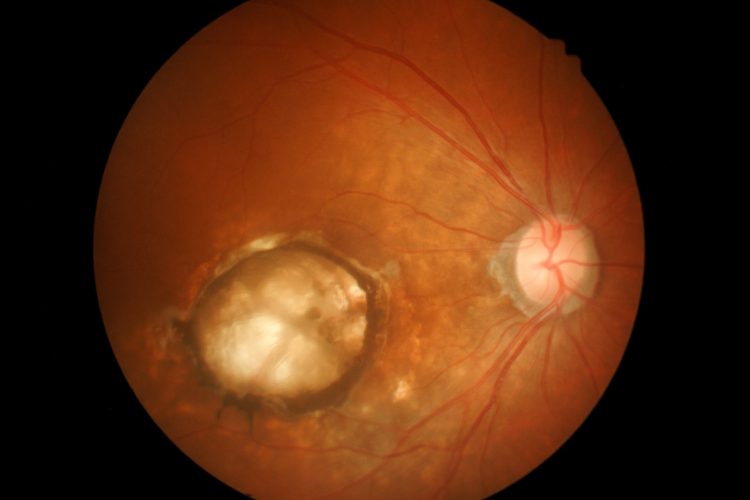 opticians image of the retina with a large area of macular degeneration