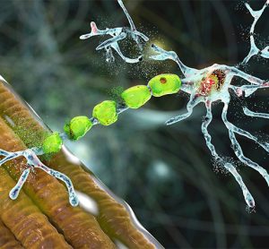 Degradation of motor neurons, conceptual 3D illustration. Motor neuron diseases are a group of neurodegenerative disorders including amyotrophic lateral sclerosis, progressive bulbar palsy and other