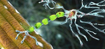 Degradation of motor neurons, conceptual 3D illustration. Motor neuron diseases are a group of neurodegenerative disorders including amyotrophic lateral sclerosis, progressive bulbar palsy and other