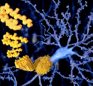 amyloid plaque forming on a neuron
