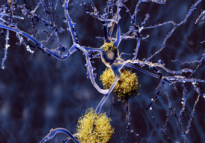 neurons in purple surrounded by yellow protein aggregates - idea of Alzheimer's disease