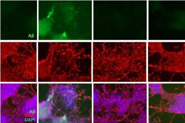 Amyloid plaques