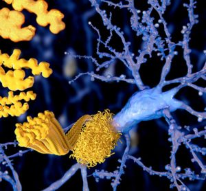 amyloid