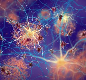 Three-dimensional (3D) illustration of amyloid beta plaques (brown mesh-like shapes) forming between neurons and disrupting their function. Amyloid plaques are a hallmark of Alzheimer’s Disease.
