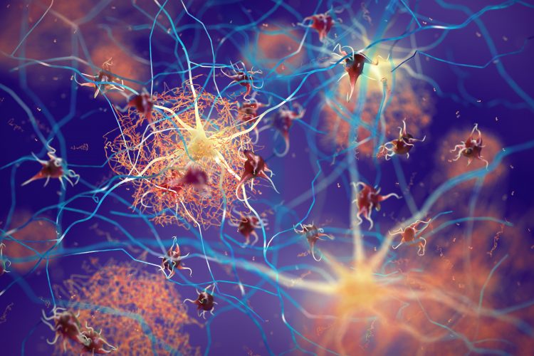 Three-dimensional (3D) illustration of amyloid beta plaques (brown mesh-like shapes) forming between neurons and disrupting their function. Amyloid plaques are a hallmark of Alzheimer’s Disease.