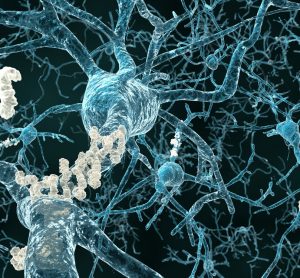 Amyloid plaque in brain