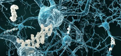 Amyloid plaque in brain