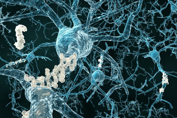 Amyloid plaque in brain