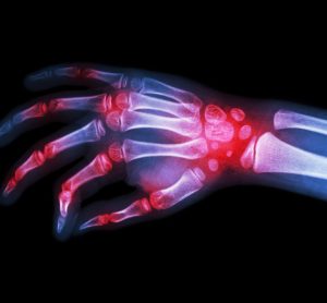 inflammation