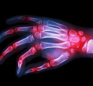 arthritis