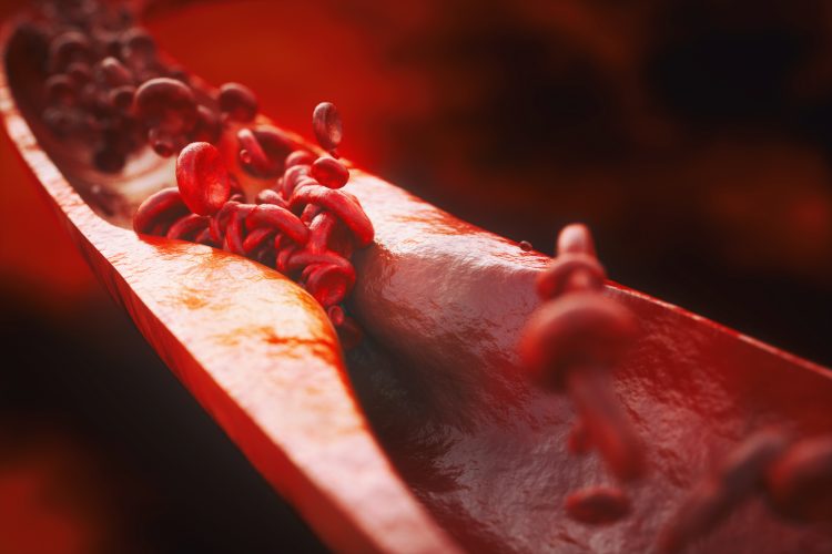 blood vessel thinned by atherosclerosis