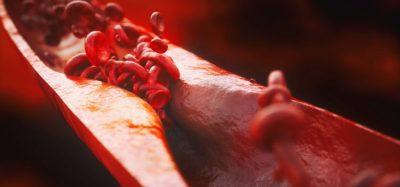 blood vessel thinned by atherosclerosis