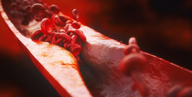 blood vessel thinned by atherosclerosis
