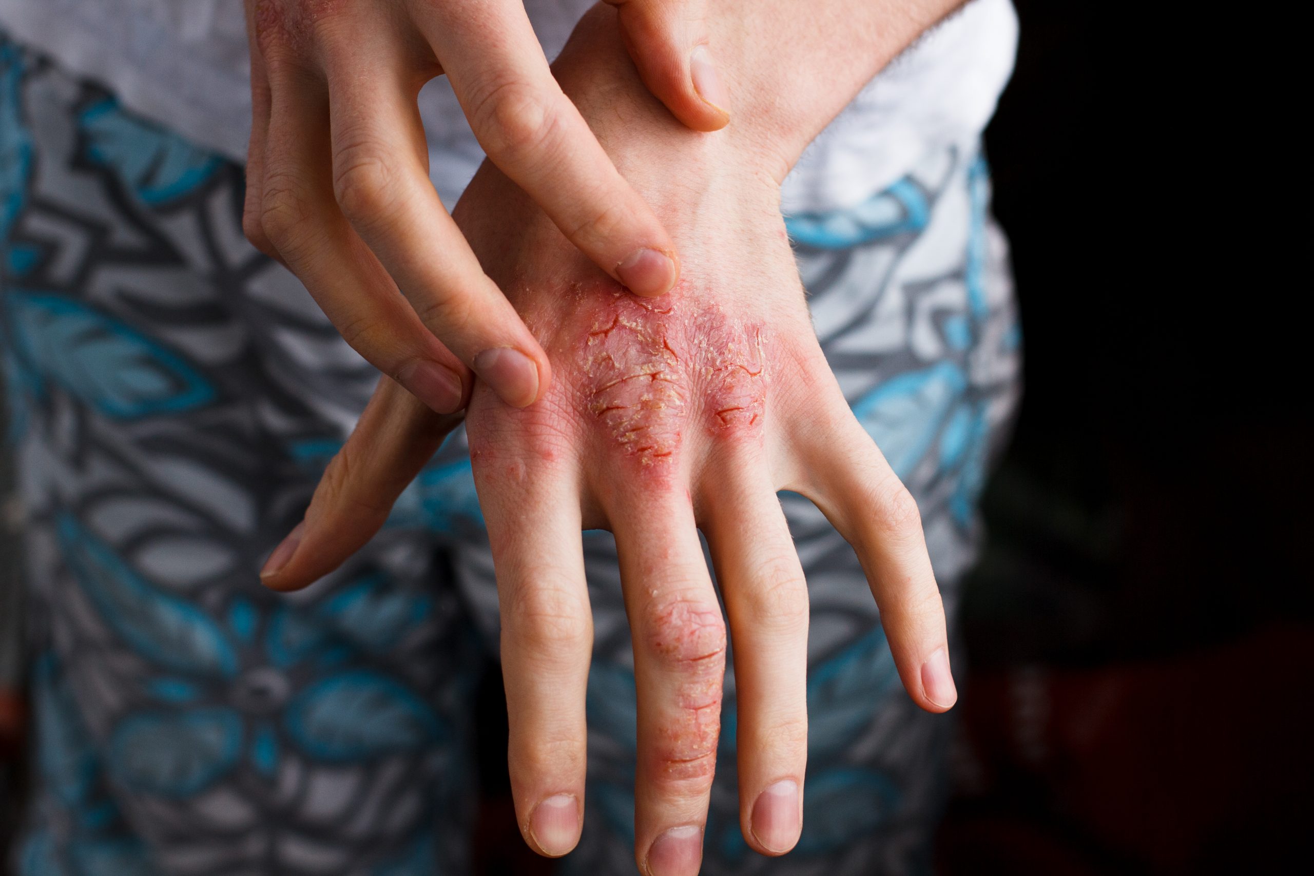 woman with red open sores on her hand - idea of atopic dermatitis flare up