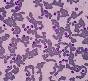 beta-thalassemia