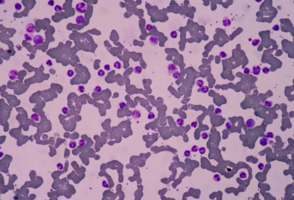 beta-thalassemia