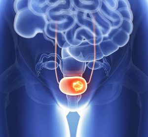 bladder cancer