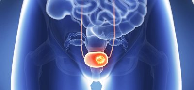 bladder cancer