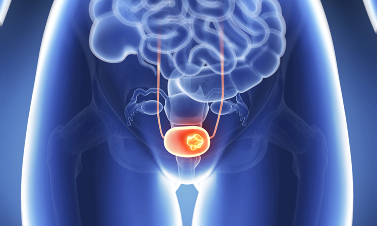 bladder cancer