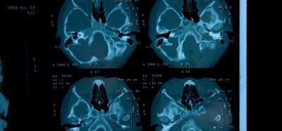 Closeup view of a MRI head scan with brain