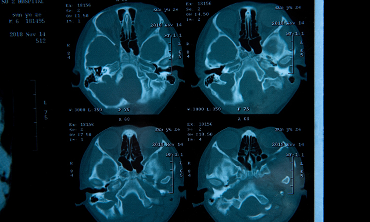 Closeup view of a MRI head scan with brain