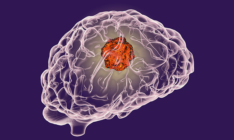 Image of cancer present in brain