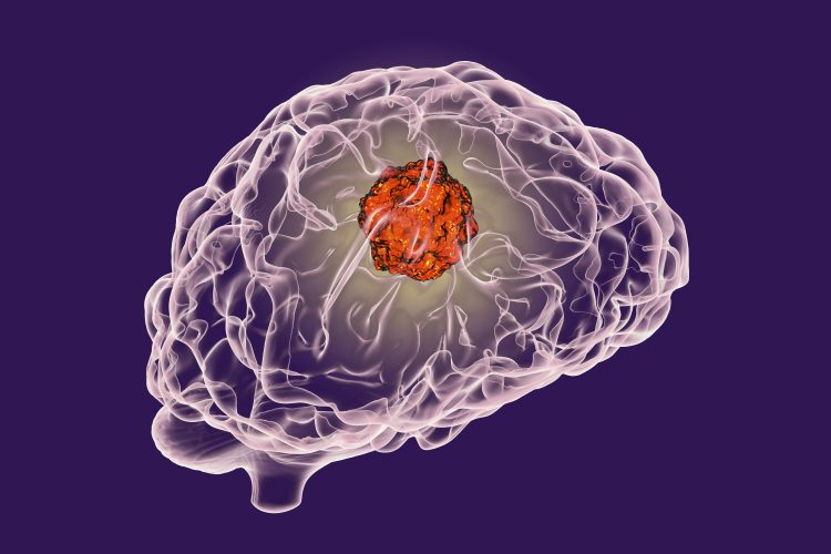 cartoon image of a brain with a large red ball inside representing a tumour