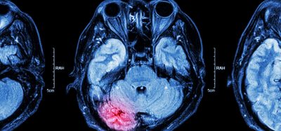 MRI scan of a traumatic brain injury with affected area highlighted in red