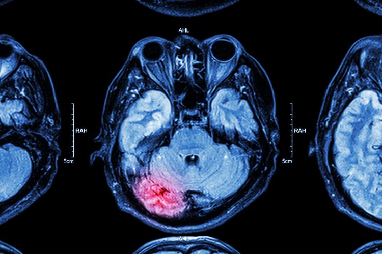 MRI scan of a traumatic brain injury with affected area highlighted in red