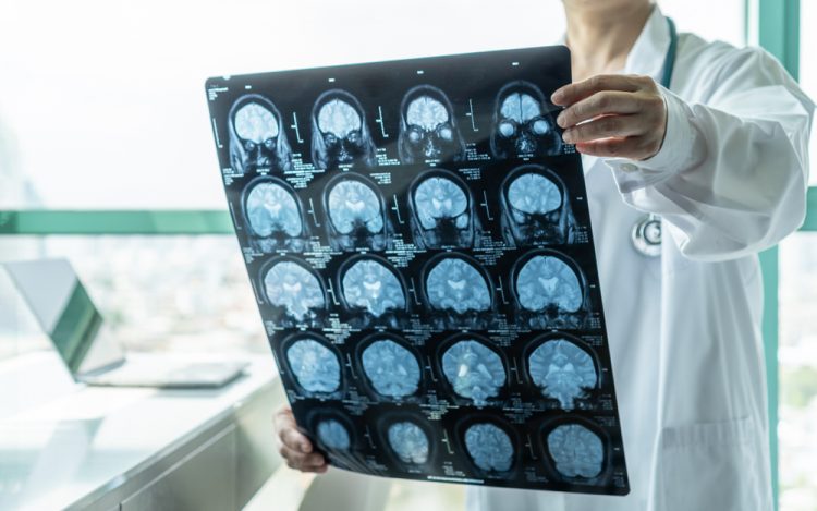 Brain scan - Alzheimer's
