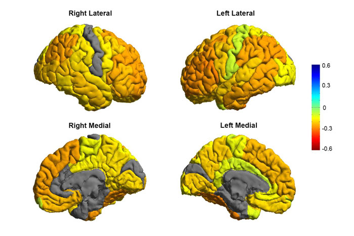 Researchers create a roadmap of bipolar disorder 