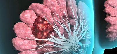 Breast cancer Girl with breast pathology. . Illustration and close-up of female human structure. 3D illustration