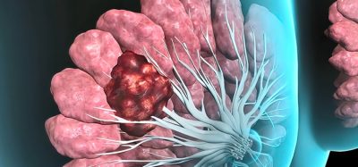 3D illustration of breast cancer