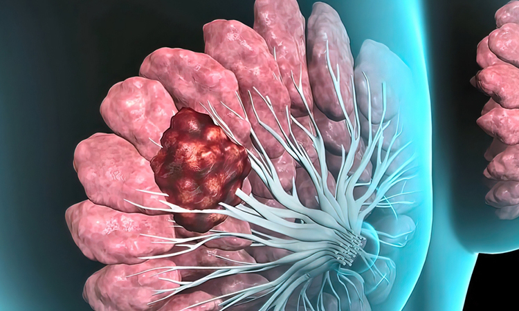 3D illustration of breast cancer