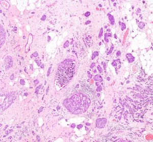 New treatment for aggressive breast cancer