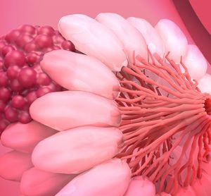 breast cancer