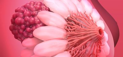 breast cancer