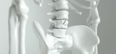 Image showing broken bone / Osteoporosis on the spine