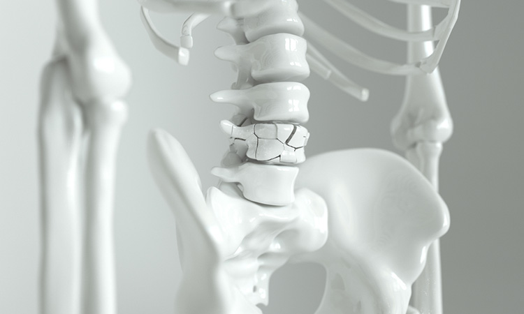 Image showing broken bone / Osteoporosis on the spine
