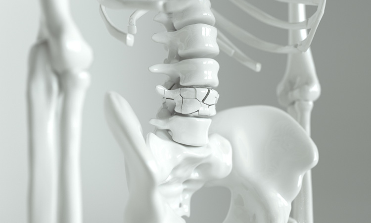 Image showing broken bone / Osteoporosis on the spine