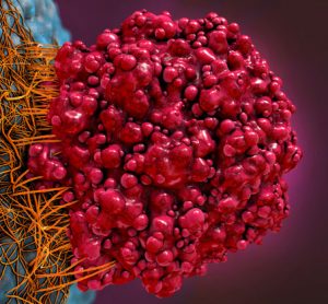 A new therapy proves effective against brain metastasis