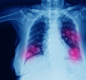 chest imaging showing cancer metastases in both of the lungs